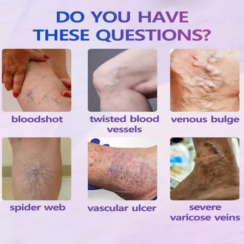 Laser Treatment for Phlebitis/Vasculitis | Anti-Swelling, Vein Bulge Pain & Circulation Aid