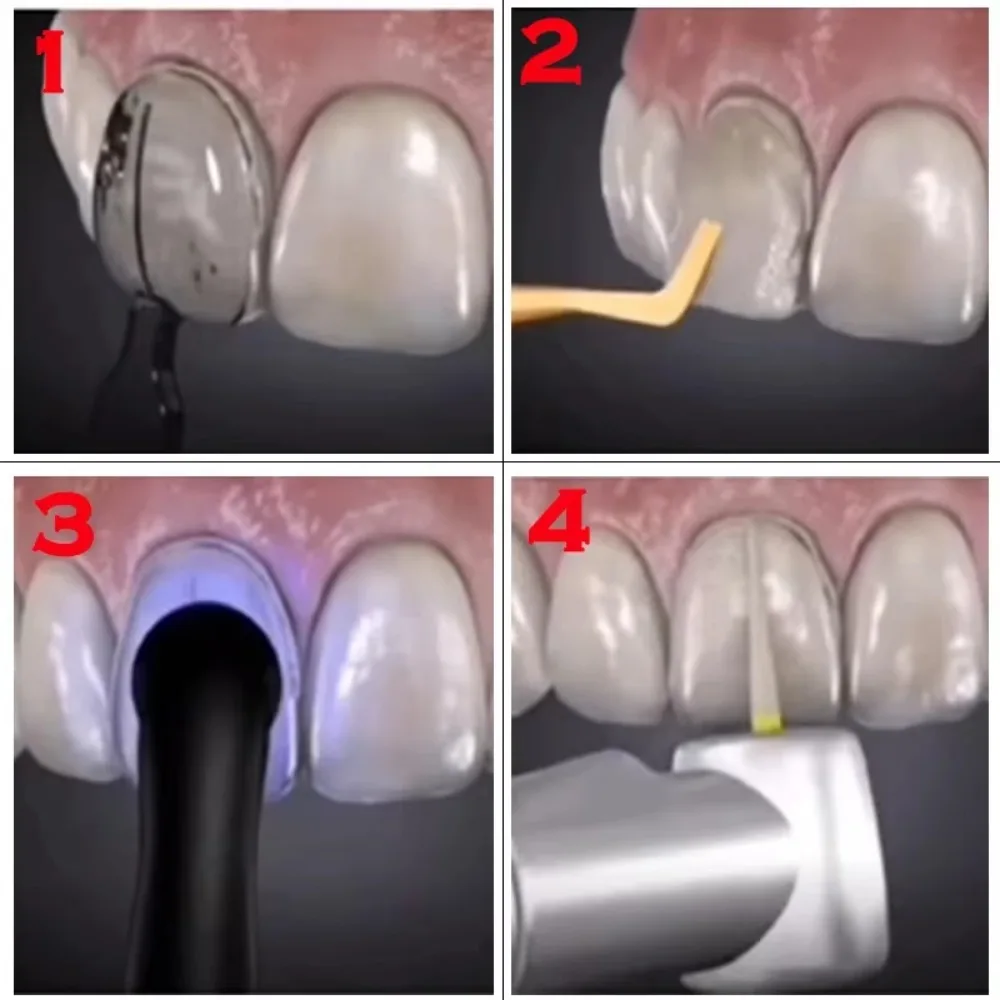 32 sztuk/zestaw zestaw fornirów dentystycznych forma z żywicy kompozytowej lekkie utwardzanie Anteriorteeth formy dentysta wybielanie materiały