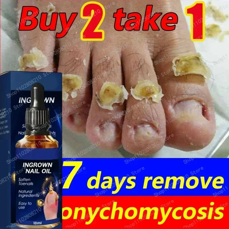 ขายร้อน Fungal NAIL Removal 10ML Fungal NAIL Foot Repair Essence เล็บเชื้อราเจลกําจัด Anti Infection