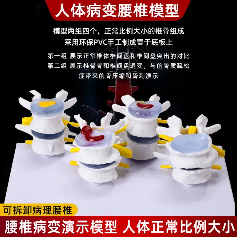 Trauma Teaching Human Anatomy Skeleton Spine 4-Stage Lumbar Model with Brain Skull