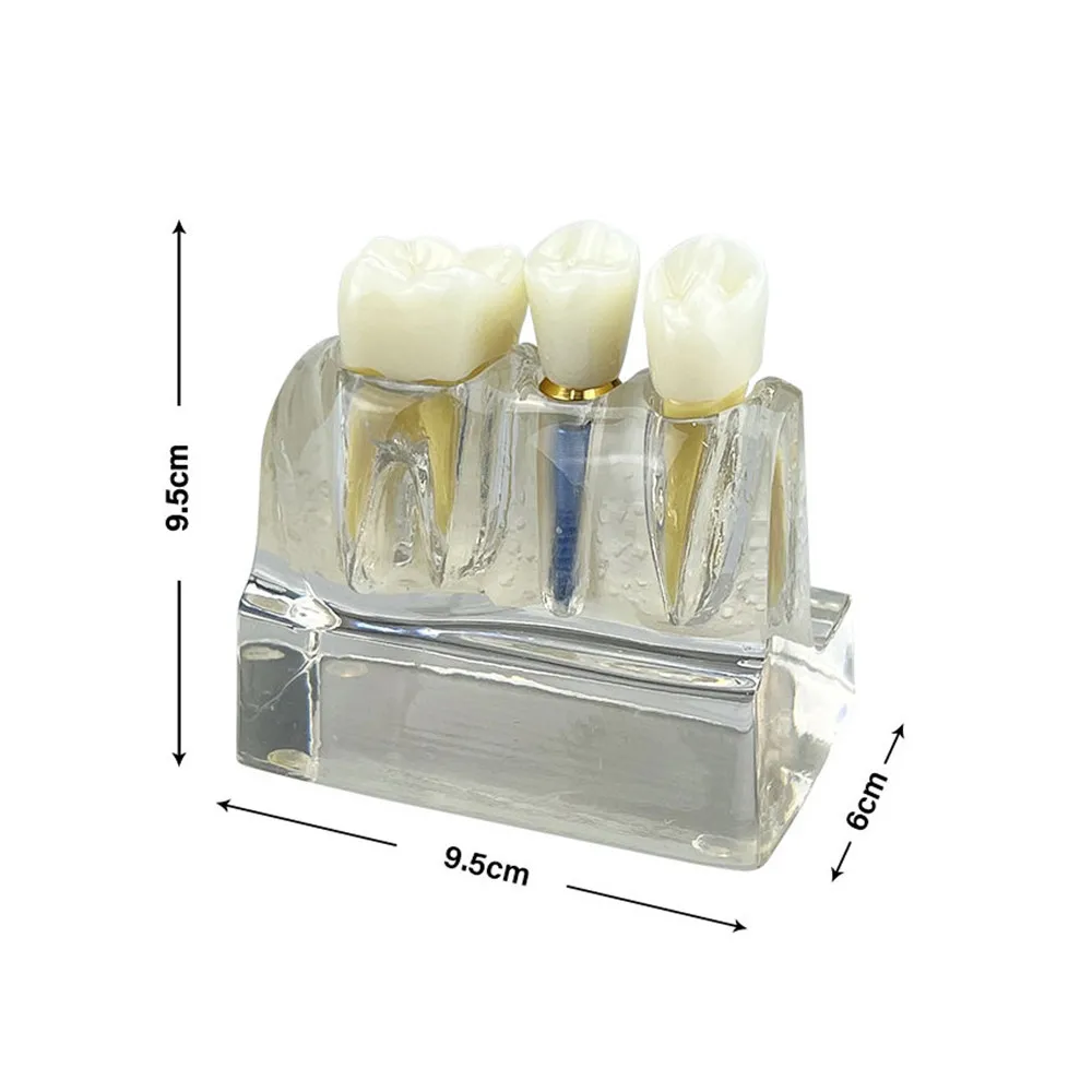 Dental Implant Training Model 4 Times Implant Analysis Crown Bridge Teeth Model Dentist Demonstration Model For Teaching Study