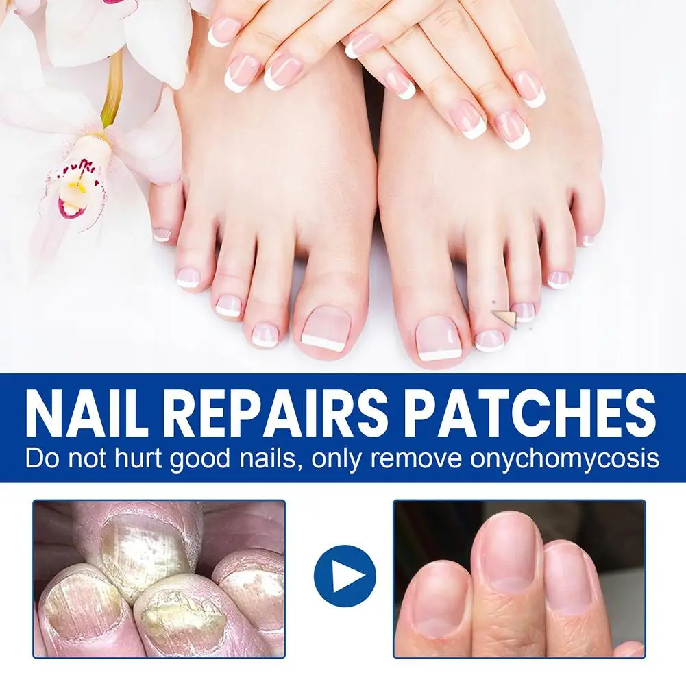 Compact Nail Repair Stickers Ingrown Toenail Correction Sticker Foot Care 60Pcs/Box New Universal Nail Ditch Repair Patch