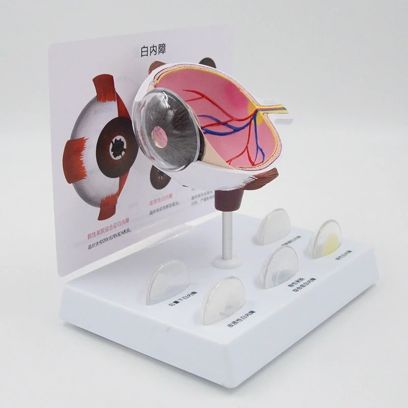 Pathological eye model Cataract eye teaching props Ophthalmic model