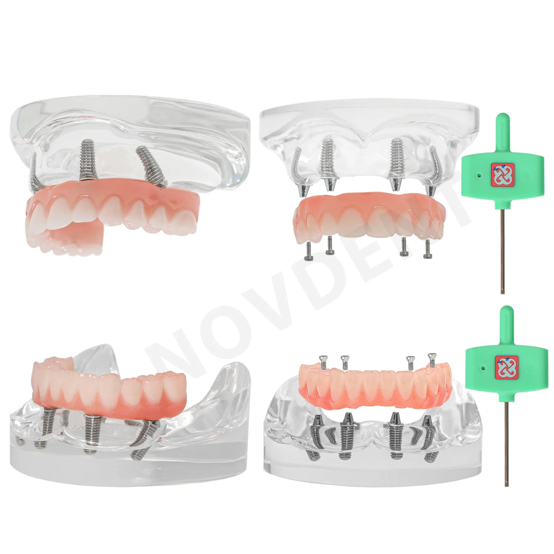 Dental Upper/Lower 4 Implants Demo Implant Teeth Study Model Restoration Overdenture