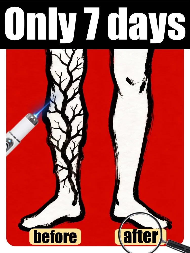 

Home leg care kit; blue light pen for treating varicose veins