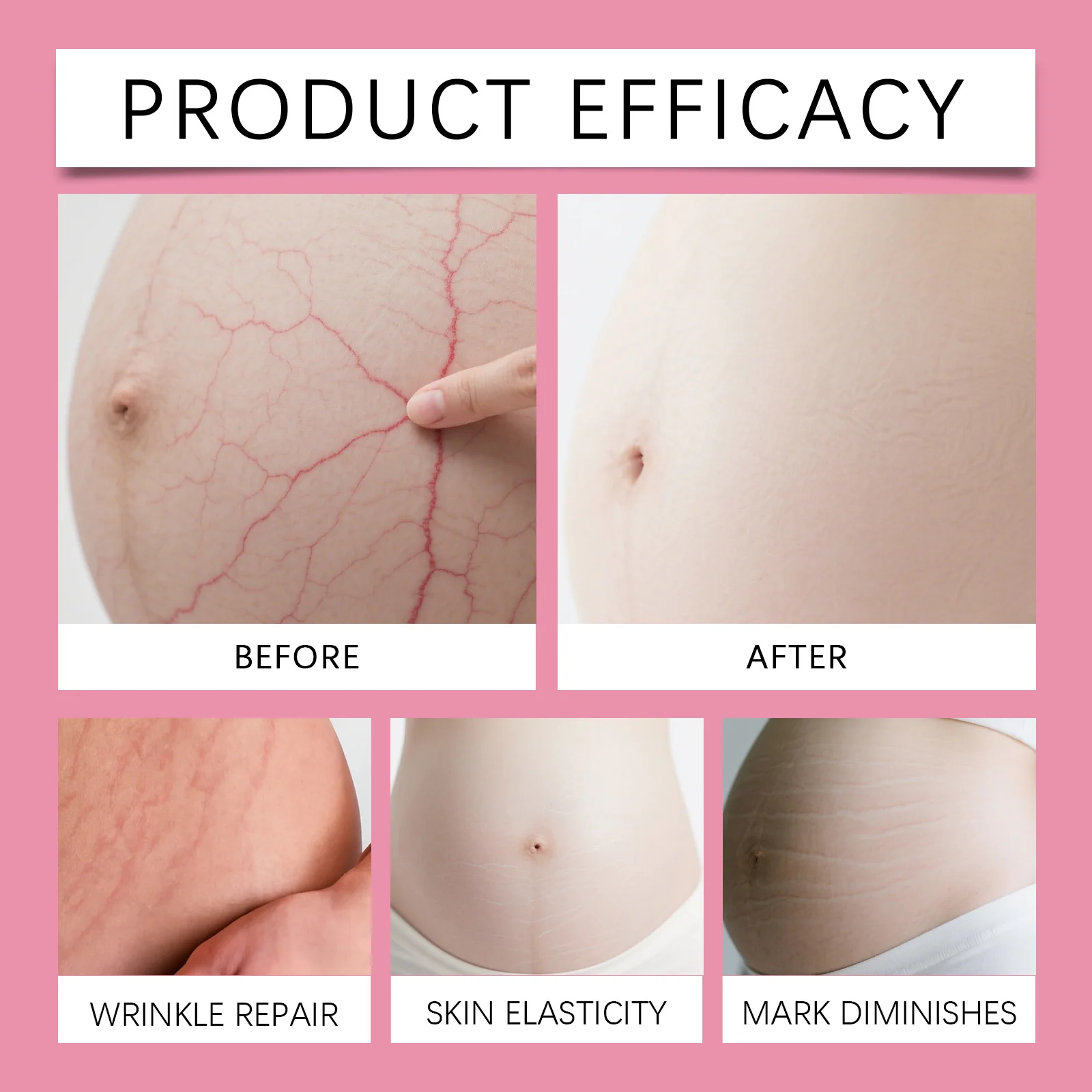 كريم علامة تمدد البطن للحمل لمرونة الكافيين ومرطب الجسم أرنيكا مهدئ للحكة العناية بالبشرة الجافة للأمهات