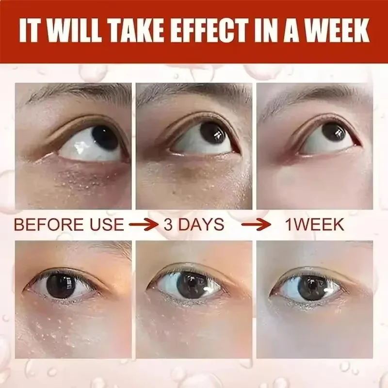 99% Salmon DNA Fat Granules Removal Eye Cream Milia Repair Products Anti Inflammatory Reduce Dark Circles Korean Skin Care