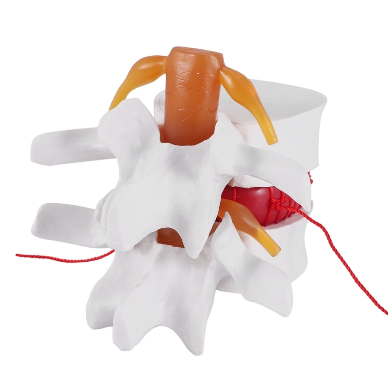 1:1.5 Human Lumbar Disc Herniation Demonstration Model Of Lumbar Vertebral Spine Model For Human Anatomy