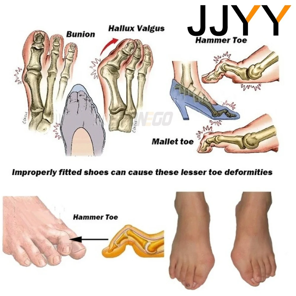Siliconen Teenseparators voor Bunion Relief Hallux Valgus Corrector Voetverzorging Pads 1 Paar Stijltangen Nail Care Tools