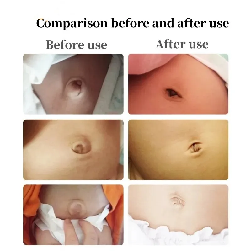 Baby Inguinal Hernia Belt Pressure Hernia Protection Belly Umbilical Cord Pure Cotton Breathable view 6