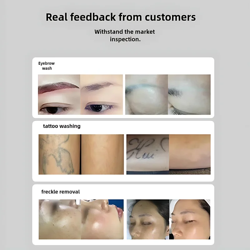 Picosecond Laser Handle for Tattoo & Mole Removal - Effective Skin Whitening, Eyebrow Tattoo Fading, and Beauty Enhancement Tool