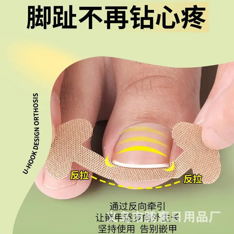Nail Repair Pulling Adhesive Free Quick Foot and Nail Deformation Patch Foot and Nail Anti Nail Embedding Correction