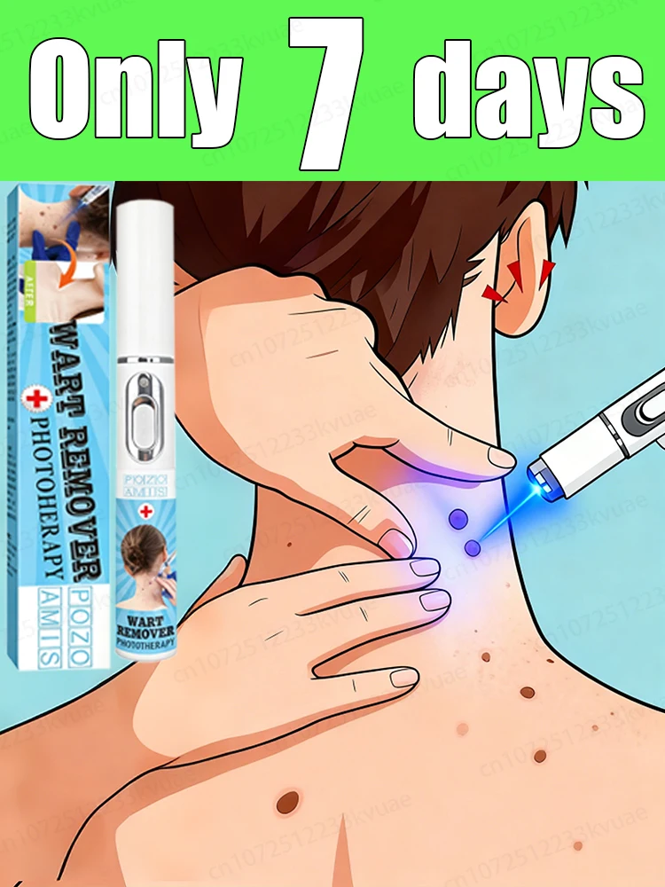 

Generation-3 Laser Says Goodbye To Warts In 7 Days