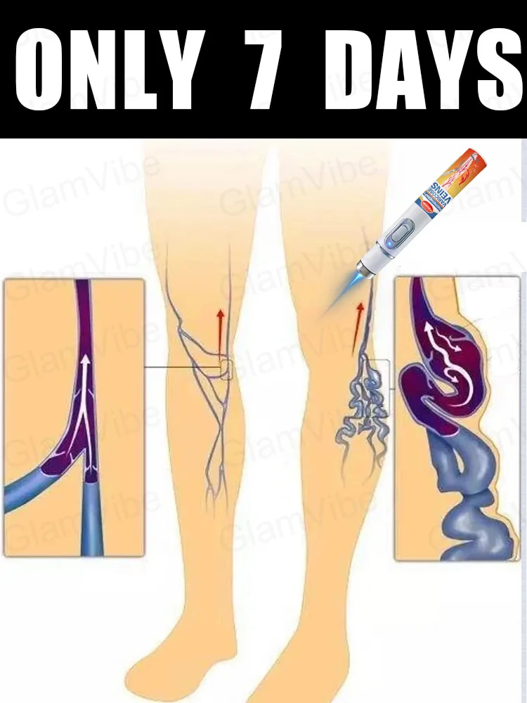 

blue light pen solve varicose veins, hot sale leg care tools