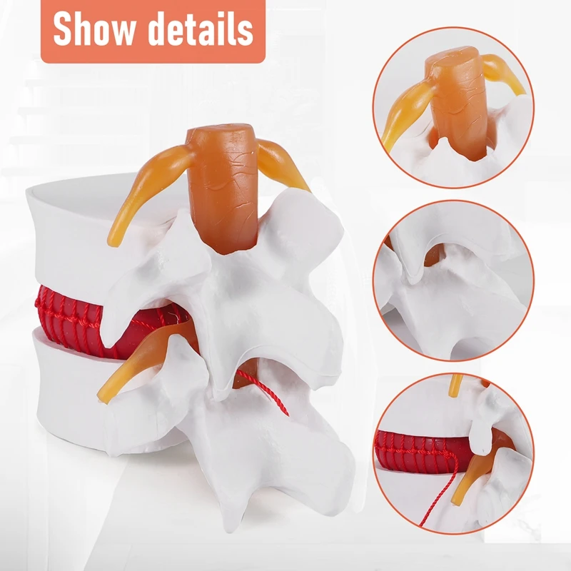 1:1.5 Human Lumbar Disc Herniation Demonstration Model Of Lumbar Vertebral Spine Model For Human Anatomy