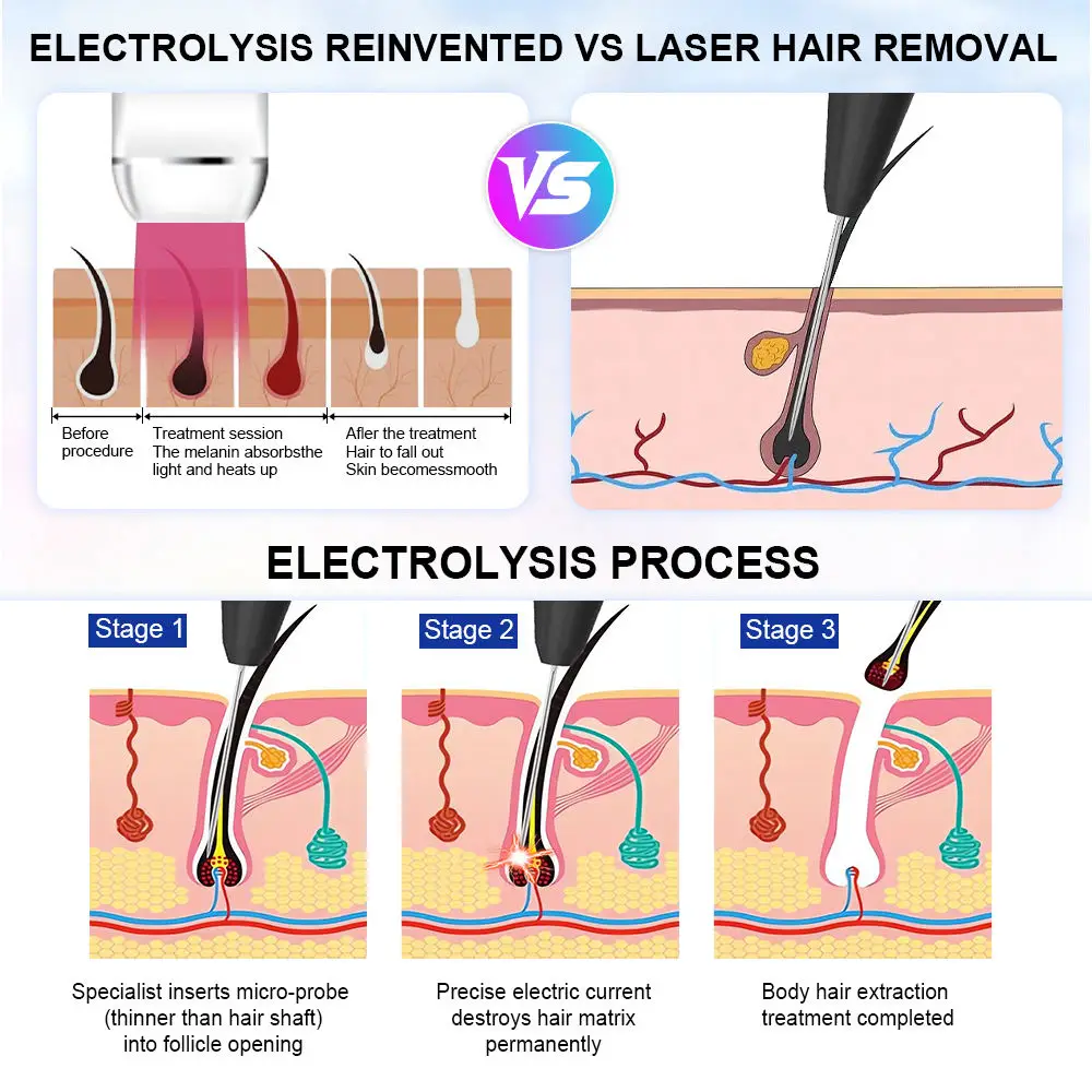 2 IN 1 Permanent Hair Removal Machine for Body Bikini Home Salon 27.12MHz Electrolysis Hair Removal Device with Hot Cold Hammer
