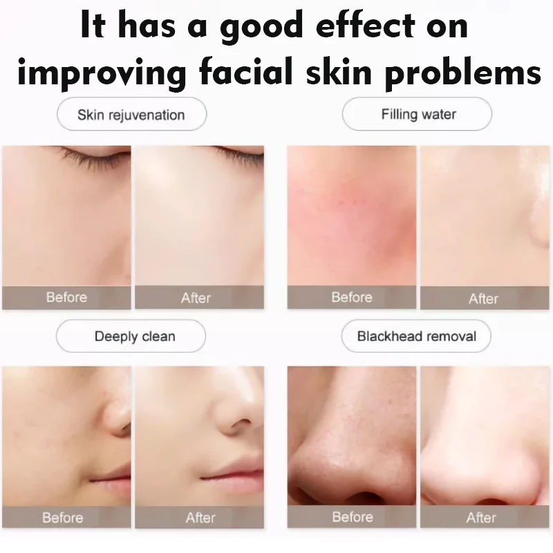 Рисунок 3 - Кислородная дермабразия 7 в 1