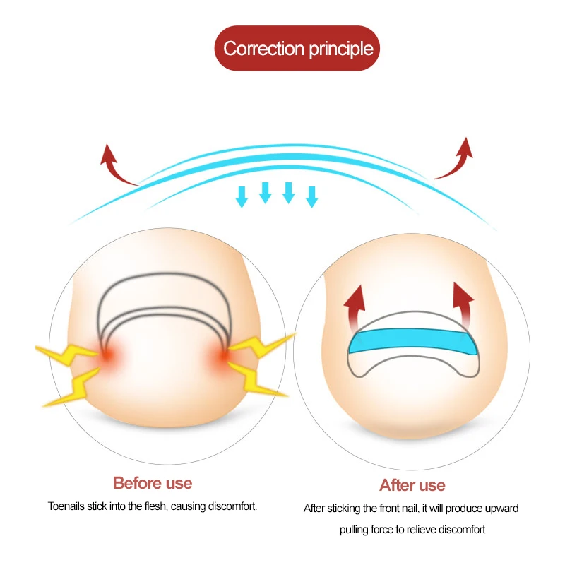 Wrastający palec u nogi wrastający paznokieć narzędzie do korekcji elastyczna naszywka naklejka klips do prostowania Brace narzędzia do Pedicure