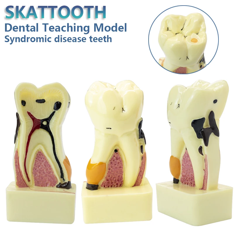 Dental Teaching Model Disease Tooth Model for Dentist Teaching Learning Doctor-patient Communication Dental Anatomical Model