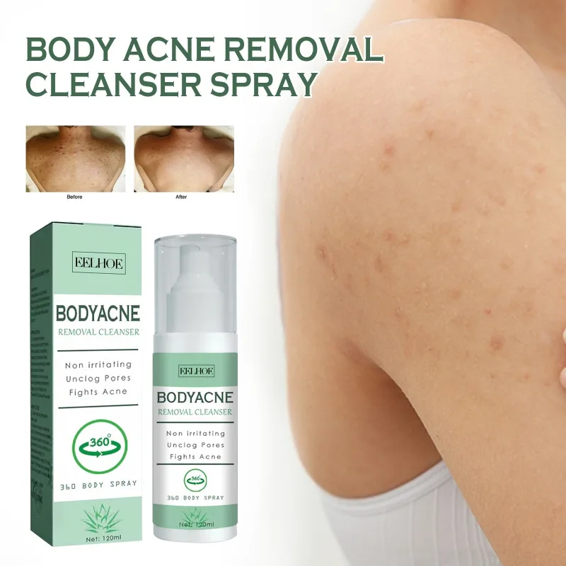 Body Acne Removal Cleanser Spray Anti-acne Water-oil Balance Remove Redness Shrinking Pores Clean Body Pimple Remover Spray