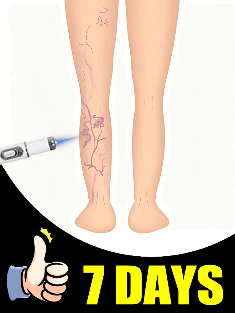 

blue light pen solve varicose veins Circulation & Leg Fatigue