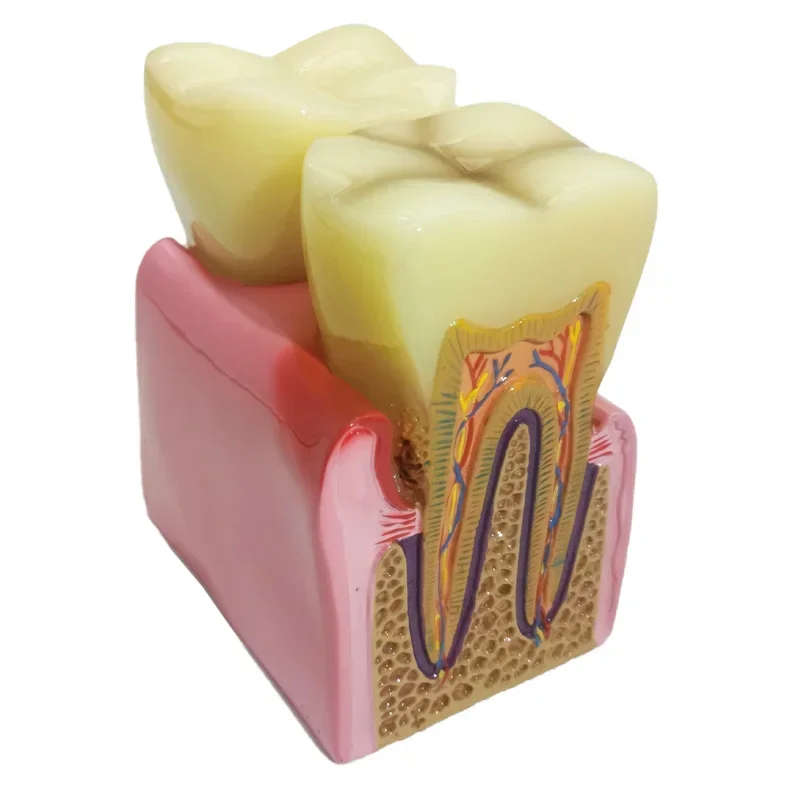 Dentals Model Caries Disease Periodontitis Case Analysis Teeth Model for Dentals Demonstration Model Dentist Teaching