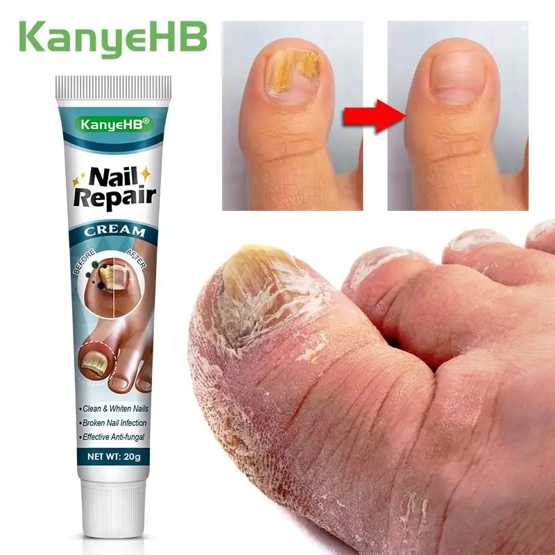 1pcs Nail Antibacterial Cream Nail Fall Off Nail Discoloration Onychomycosis Treatment Cream Toes Nail Fungus Removal Cream G048