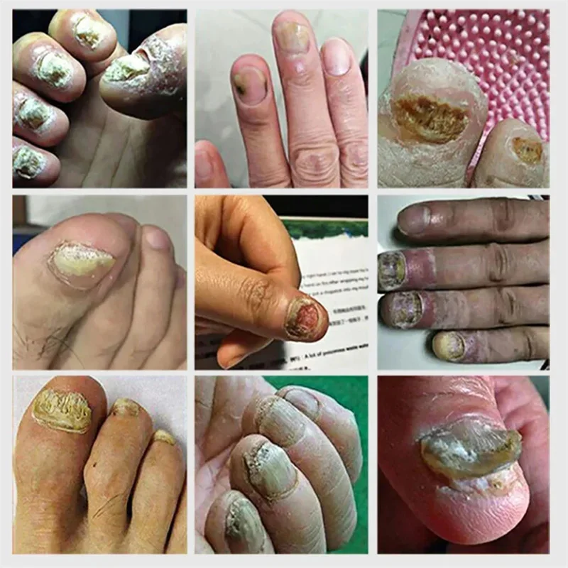 Serum perawatan kuku jamur penghilang jamur kuku kaki Gel perbaikan Anti infeksi Paronychia Onychomycosis esensi perawatan kuku kaki