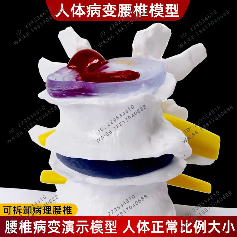 Human Four-Team Four-Stage Pathology Lumbar Spine Skeletal Anatomy Intervertebral Disc  Joint Herniated Deformation Model