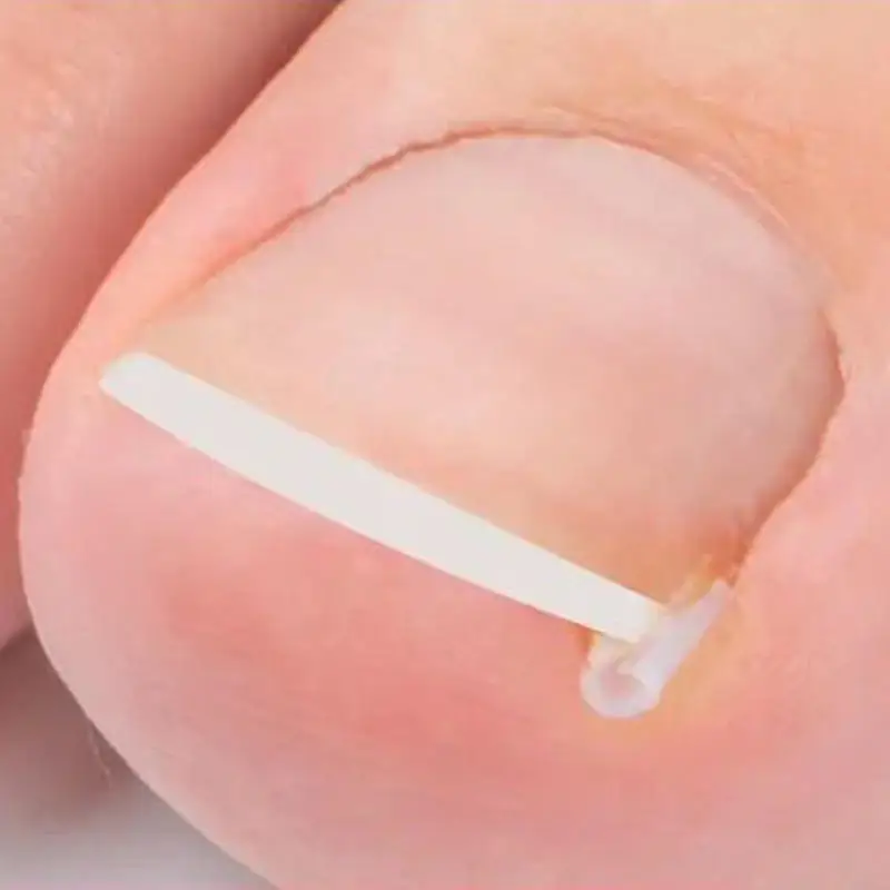 50Pcs Ingrown Toe Nail Treatment Elastic Patch Sticker Straightening Clip Brace Pedicure Tool Ingrown Toenail Correction Tool