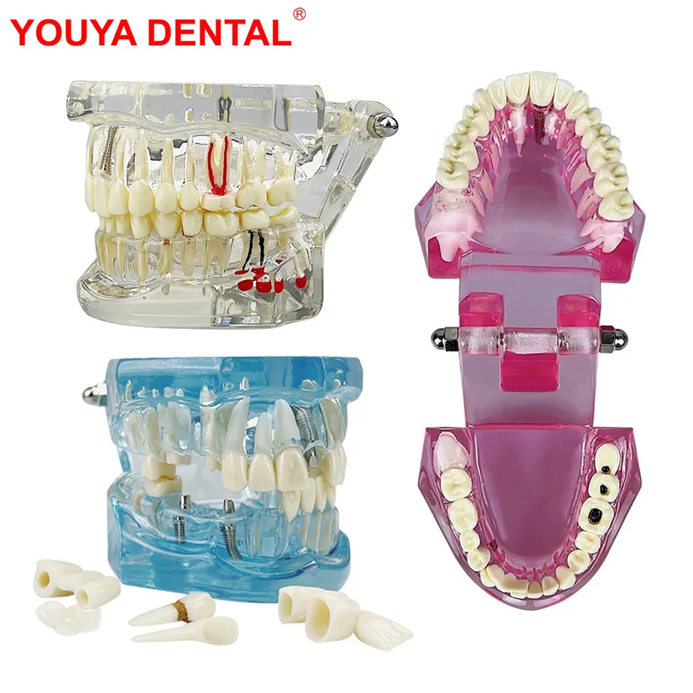 

New Dental Model Teeth Implant Restoration Bridge Removable Teeth Model Implant Disease Dentist Studying Education Demonstration