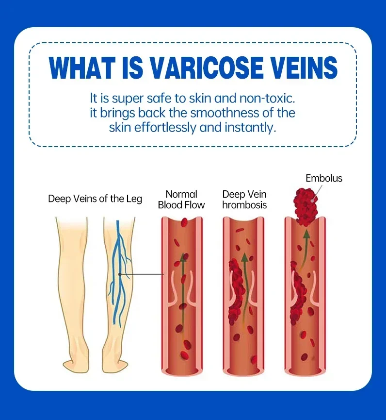 Efficace crema per il trattamento delle vene Varicose rimuovi le strisce di sangue rosso Varicose vasculite flebite rafforza la salute dei capillari