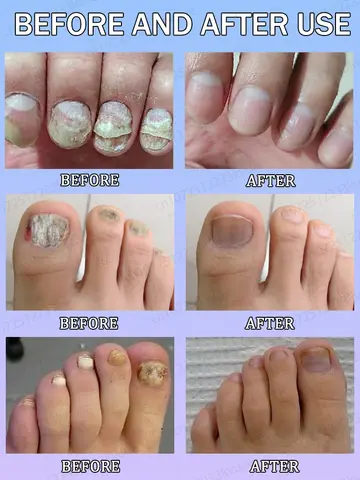 10 best sales फंगस नाखून उपचार - №6