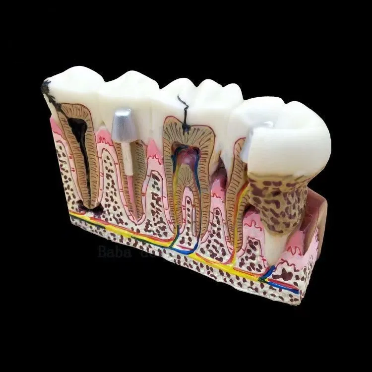 Dentistry Dental caries anatomy model Doctor-patient communication Dental nerve oral model free shipping