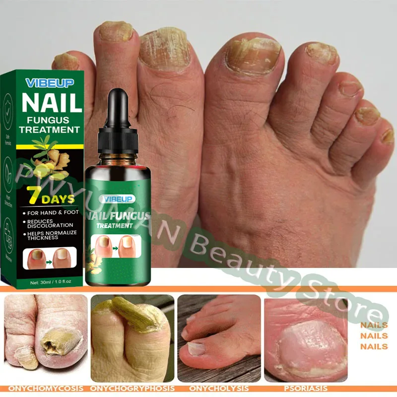 

7-дневная сыворотка для лечения грибка ногтей, имбирная антиинфекционная паронихия, онихомикоз, гель для восстановления грибка ногтей, уход за руками и ногами