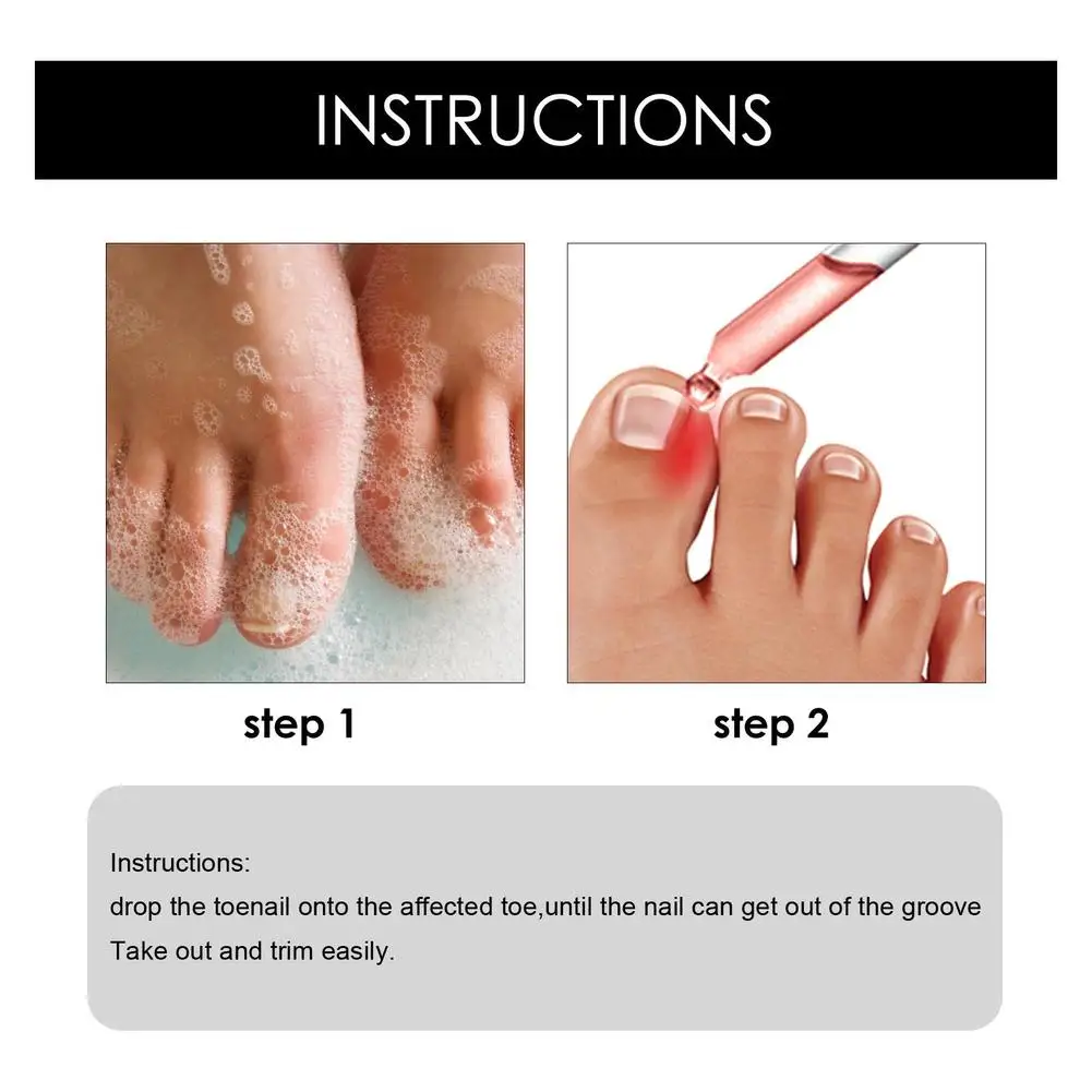 Ingrown Toenail Tratamento Soro, Correção das unhas, Recuperar Óleo, Pain Reliever, Unhas Amaciante, Guarnição com Facilidade Óleo, Saúde Pés, 3 Pcs, 2 Pcs, 1Pc