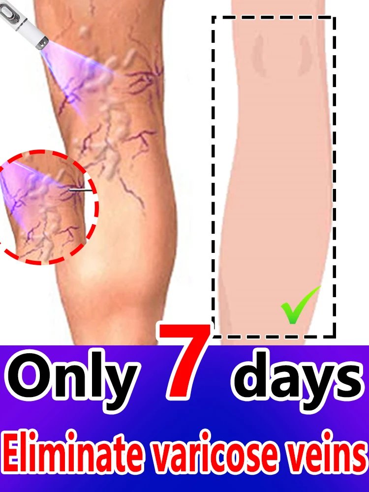 

Leg care tools eliminate spider leg varicose veins blue light pen for Men Women All People