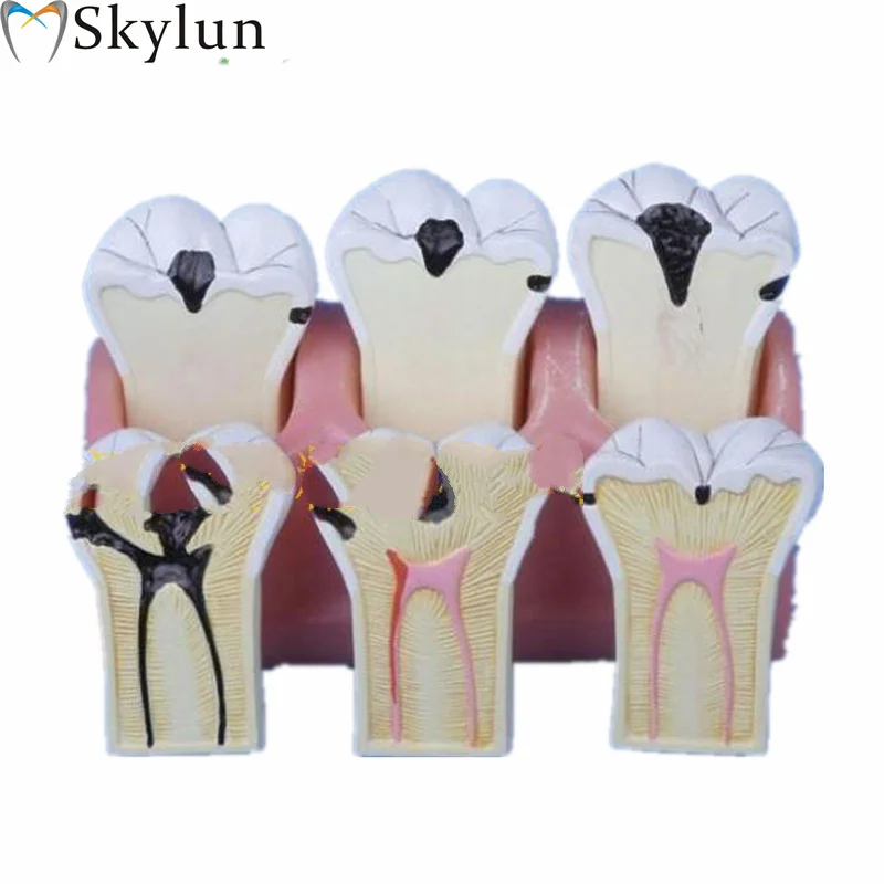 Dental Caries Decomposition Model dental teaching Model human molar teeth model SL718