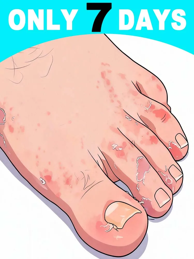 

Hᴇᴀʟɪɴɢ Fᴏᴏᴛ Uʟᴄᴇʀs, Tɪɴᴇᴀ Pᴇᴅɪs, Aɴᴅ Fᴜɴɢᴀʟ Iɴғᴇᴄᴛɪᴏɴs Oғ Tʜᴇ Fᴇᴇᴛ Hot selling