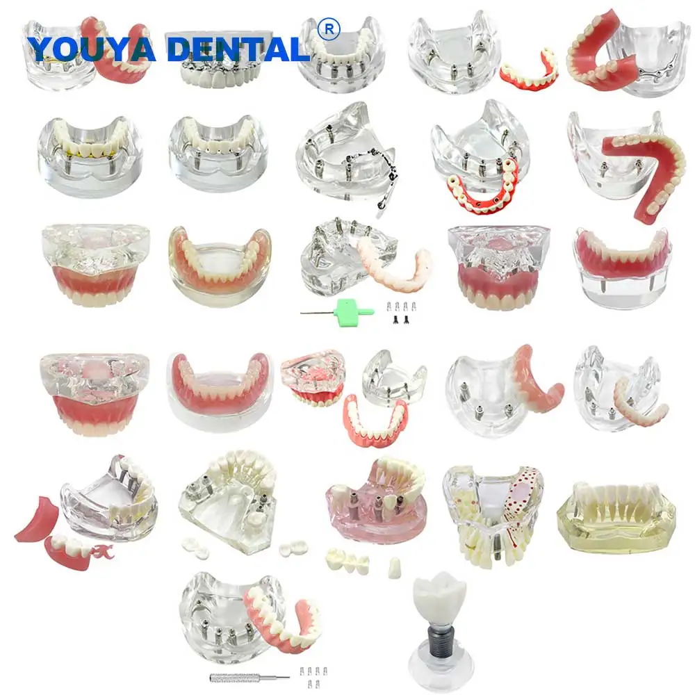 

Стоматологические нижние 4/6 имплантаты, съемные, восстановление зубов, верхняя часть зубов, модель стоматолога, образование студентов, имплантат Typodont