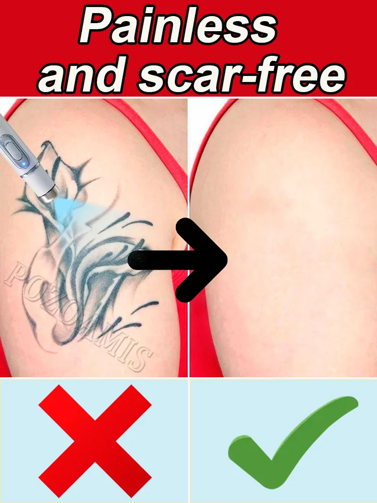 

Безболезненное удаление татуировок, дерьмо разные зоны времени в зависимости от размера, цвета или узора.