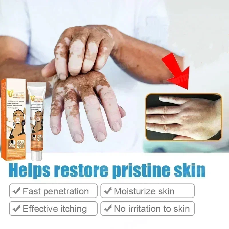 Vitiligo-Creme, entfernt Ringelflechte, entfernt weiße Flecken und entfernt die Haut Vitiligo, beseitigt Vitiligo-Creme