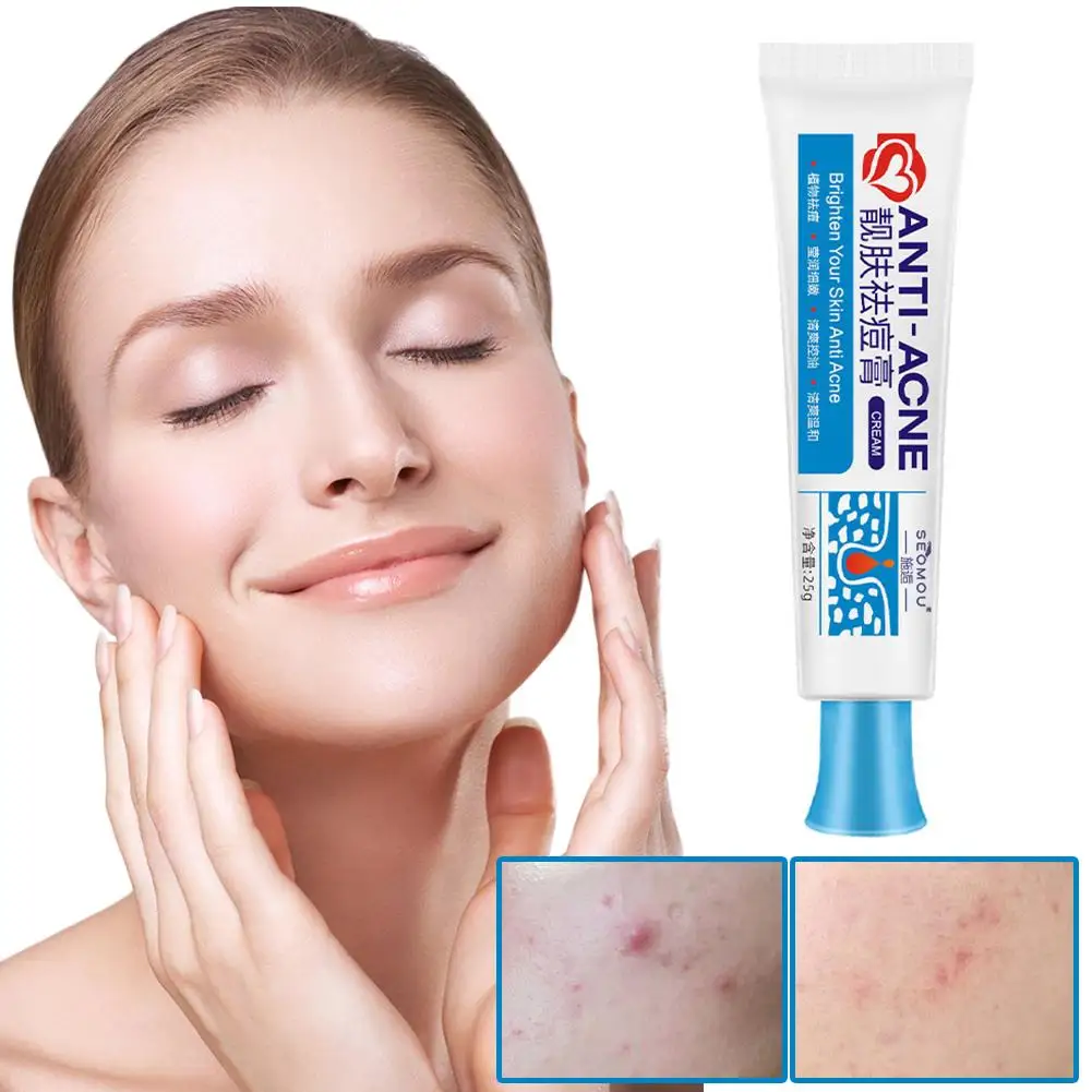 

1pcs Acne Removal Cream Spots Scar Treatment Whitening Shrink Oil Products Health Care Moisturizing Beauty Control Skin Por E0S7