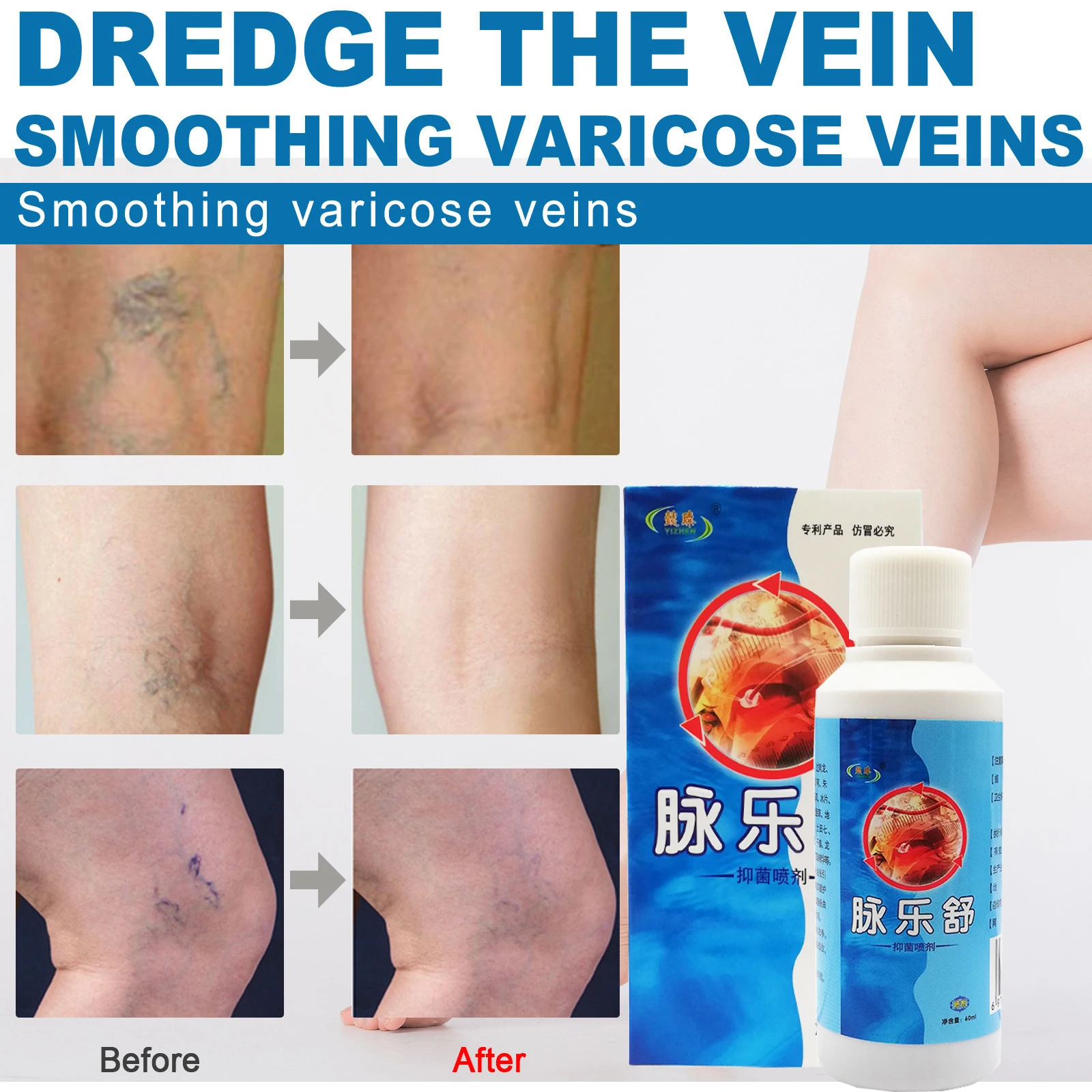 Varicose Veins Spray Blood Vessels Bulge Relief Phlebitis Angiitis Remedy Edema Nerve Pain Spider Edema Nerve Leg Active Liquid