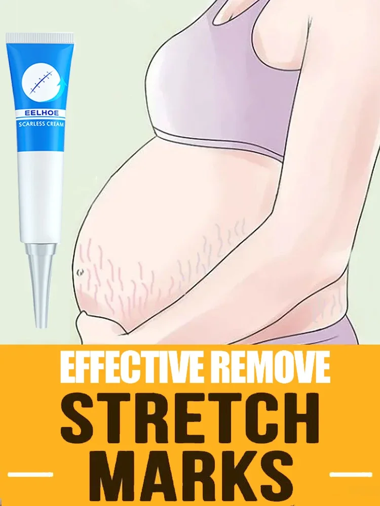 

Pregnancy Stretch Marks Removal Effective Treatment Eliminate Red White Old Marks Moisturize and Repair Removal Cream