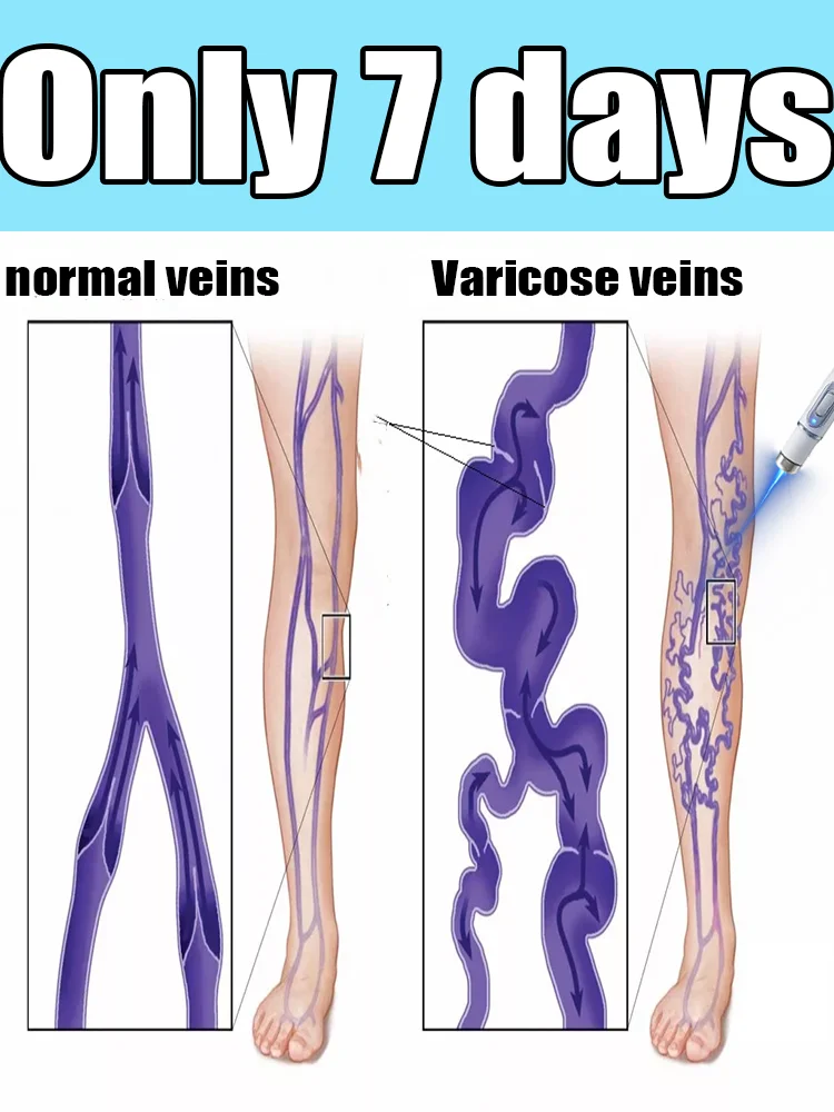 

Lᴀsᴇʀ ɪɴsᴛʀᴜᴍᴇɴᴛ ғᴏʀ ᴠᴀʀɪᴄᴏsᴇ ᴠᴇɪɴ ᴄᴏʀʀᴇᴄᴛɪᴏɴ