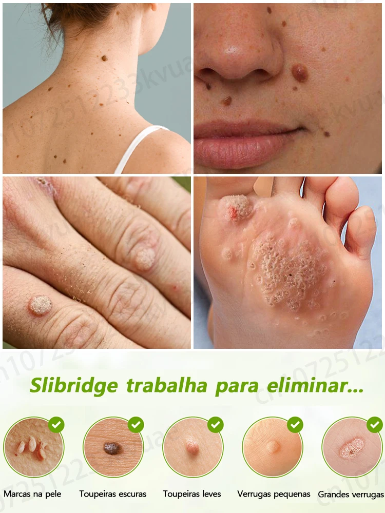 El bolígrafo láser elimina con precisión las verrugas sin cicatrices ni recurrencias.