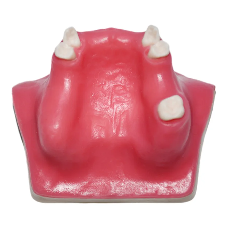 

Dental Implant Teeth Model Oral Implantation Training Practice Model Teaching Exercise Dentist Doctor-Patient Communication Tool