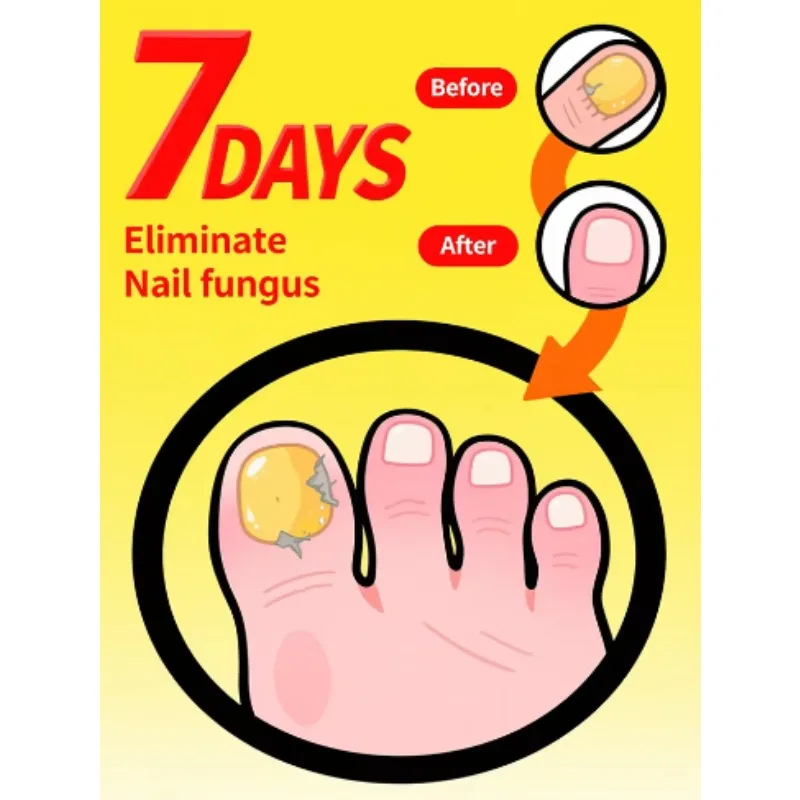 Solution de réparation de soins fongiques, pour l'onychomycose, élimination indolore, gel, produits