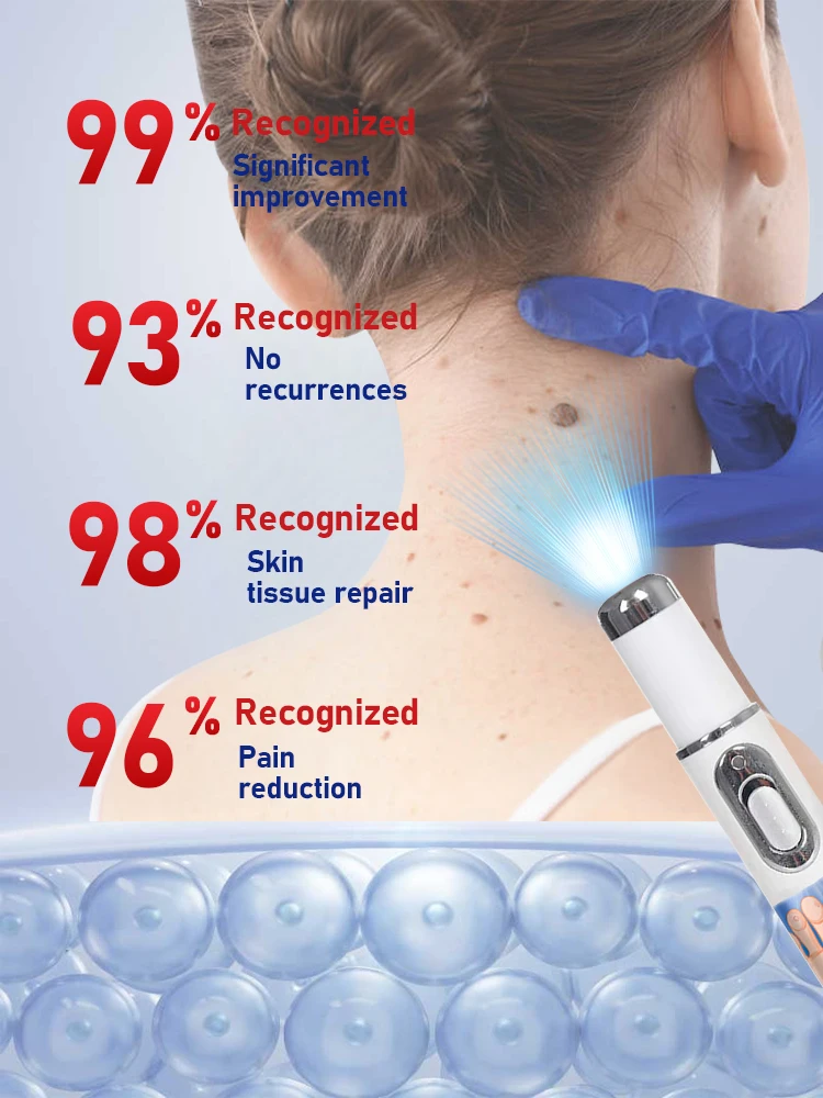 Remoção de verrugas a laser para tratamento de pescoço, obtenha verrugas cauterizador creme de verrugas adulto